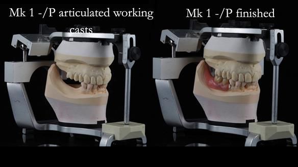 Newsletter 54 case presentation upper complete denture and lower Scandinavian designed hygienic partial denture for David