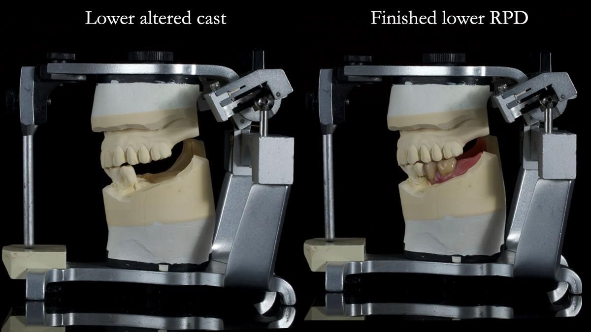 Newsletter 87 – Father Peter: A Partial Denture that needed Minor Miracle