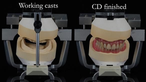 Finlay's Newsletter 62 provision of extractions and metal based complete dentures for Rafique