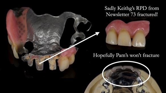 Newsletter 81 - Pam’s Story — how a partial denture changed her life (+ live walkthrough this Thursday)
