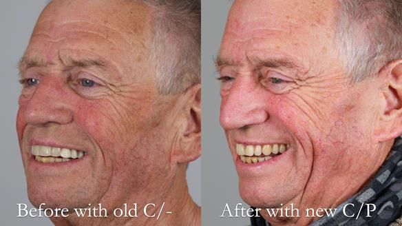 Newsletter 54 case presentation upper complete denture and lower Scandinavian designed hygienic partial denture for David