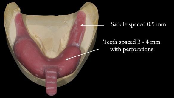 Newsletter 52 Managing Jo’s failing dentition with extractions and Mk 1/Mk 2 complete upper dentures and lower partial dentures FULL PROTOCOL