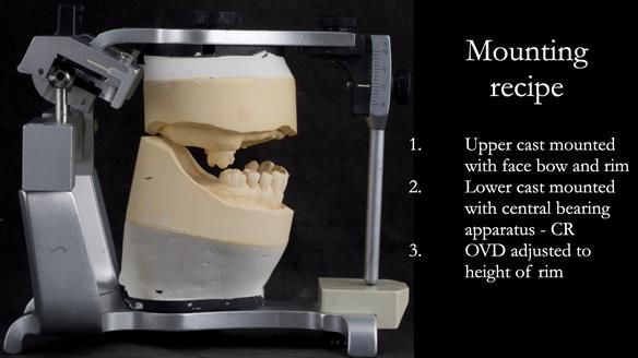 Newsletter 52 Managing Jo’s failing dentition with extractions and Mk 1/Mk 2 complete upper dentures and lower partial dentures FULL PROTOCOL