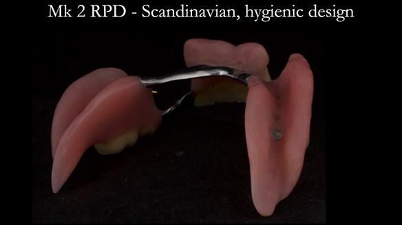Finlay's Case Study Newsletter 40 - Immediate Mk 1 RPD to Definitive Mk 2 RPD - full protocol