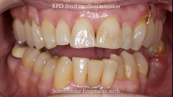 Finlay's Newsletter 60 Sylvia's upper Kennedy Class 2 Mod 1 metal based upper RPD