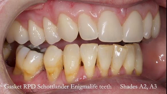 Finlay's Newsletter 58 Gasket upper partial denture for Zoe