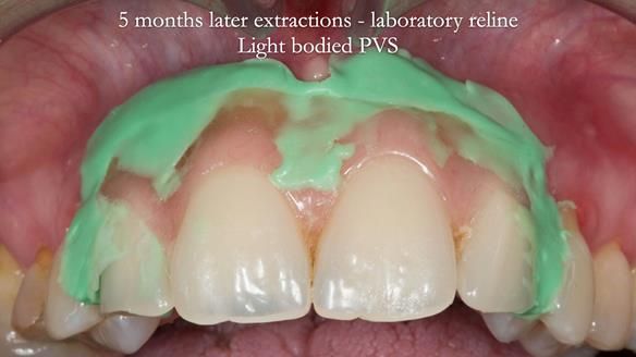Finlay's Newsletter 63 Case study provision of metal based Scandinavian RPD - functional 10 years on