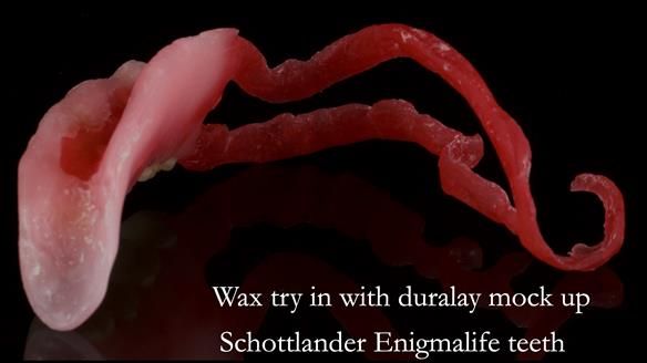 Finlay's Newsletter 61 provision of a lower unilateral free end saddle metal based partial denture for Joyce