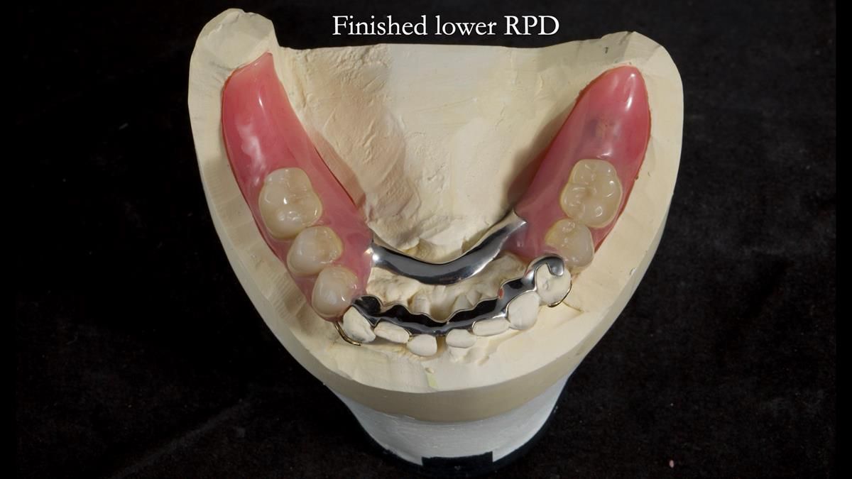Newsletter 87 – Father Peter: A Partial Denture that needed Minor Miracle