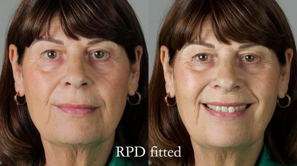 Newsletter 56 showing the making and fitting of a bilateral free end saddle upper removable partial denture (RPD) for patient with pemphigus