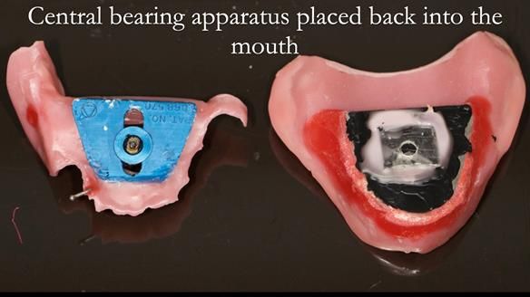Newsletter 54 case presentation upper complete denture and lower Scandinavian designed hygienic partial denture for David