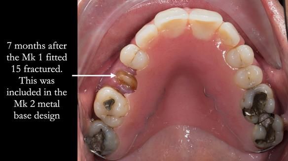 Finlay's Newsletter 63 Case study provision of metal based Scandinavian RPD - functional 10 years on