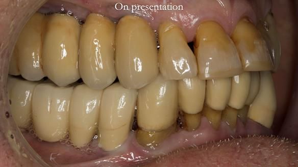 Ken – going downhill, first class