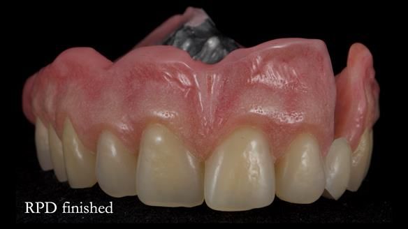 Newsletter 55 Provision of metal based partial dentures for Zephyrine with a repaired cleft lip and palate