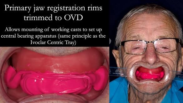 Newsletter 80 - Gordon’s dentures: the one case in 1,000 where my technique failed