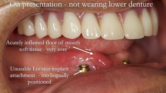 Managing poor implant positioning with complete dentures and Locator attachments - full protocol Newsletter 41