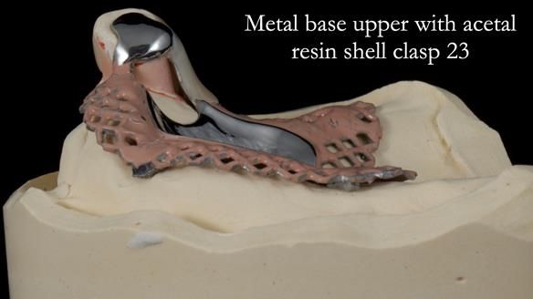 Newsletter 55 Provision of metal based partial dentures for Zephyrine with a repaired cleft lip and palate