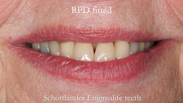 Finlay's Newsletter 59 Ultra hard partial dentures made for Gill