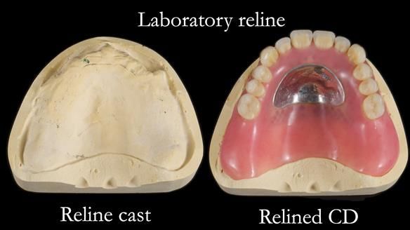 Finlay's Newsletter 62 provision of extractions and metal based complete dentures for Rafique