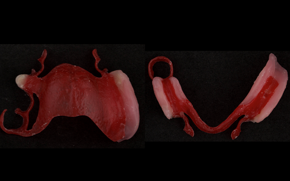 Figure 60 Teeth try in on pattern resin bases intaglio surfaces. These help to confirm the accuracy of the working casts and the amount of metal work which will be visible in the final dentures