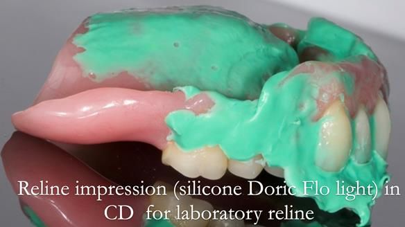 Finlay's Newsletter 62 provision of extractions and metal based complete dentures for Rafique