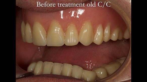 Complete denture Class II div 2 deep overbite Newsletter 39