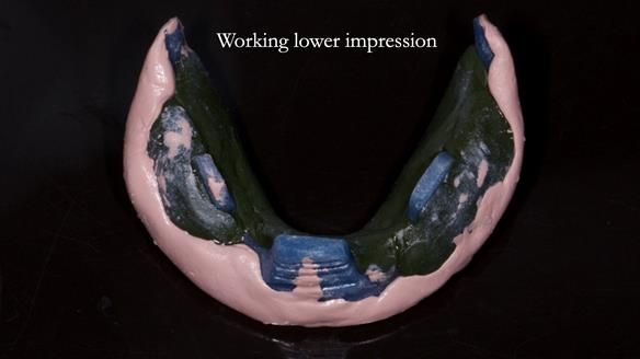 Newsletter 83: Sheila’s Complete Denture Success