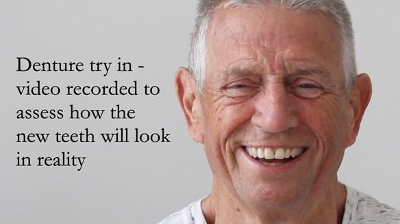 Newsletter 54 case presentation upper complete denture and lower Scandinavian designed hygienic partial denture for David