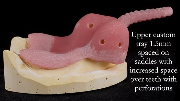 Finlay's Newsletter 59 Ultra hard partial dentures made for Gill