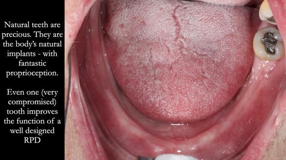 Finlay's Newsletter 59 Ultra hard partial dentures made for Gill