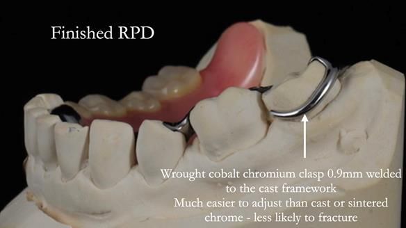 Finlay's Newsletter 61 provision of a lower unilateral free end saddle metal based partial denture for Joyce