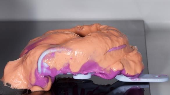 Finlay's Newsletter 64 case study - provision of a Kennedy class 2 metal based Scandinavian RPD for Ian