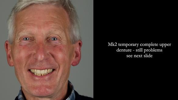 Newsletter 77: Jeremy’s case – immediate complete upper denture