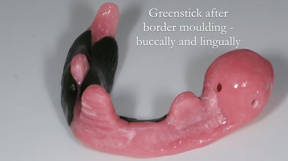 Finlay's Newsletter 59 Ultra hard partial dentures made for Gill