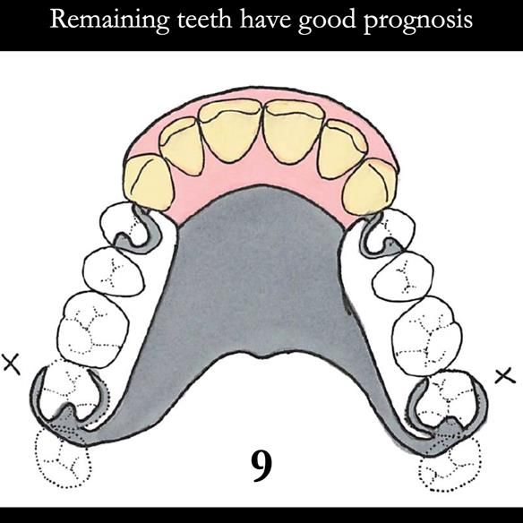 Universal Scandinavian partial denture designs