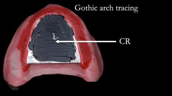 Newsletter 82 Mary - A complete upper and a one-tooth gasket denture