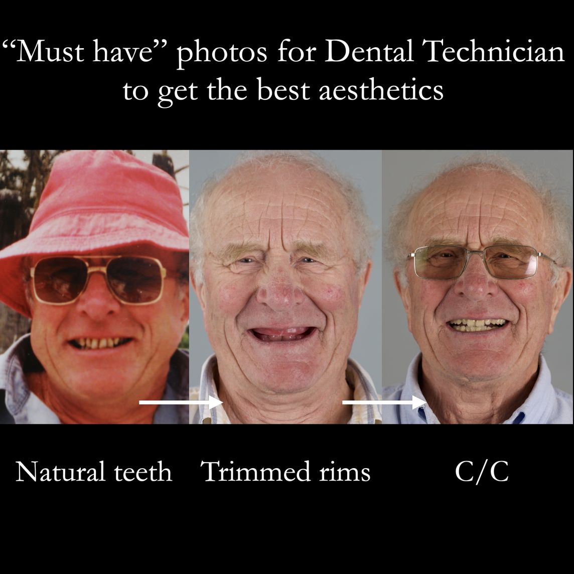 Photographs of the patient smiling with the shaped wax rims in situ – send to the technician