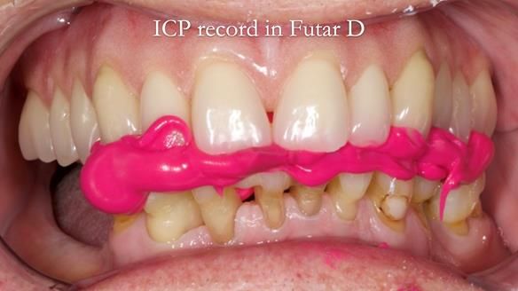 Newsletter 54 case presentation upper complete denture and lower Scandinavian designed hygienic partial denture for David