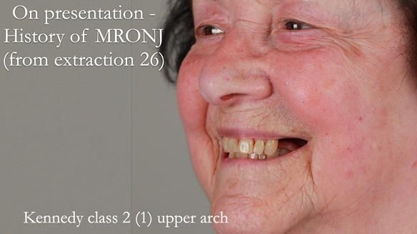 Finlay's Newsletter 60 Sylvia's upper Kennedy Class 2 Mod 1 metal based upper RPD