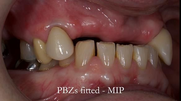 Newsletter 81 - Pam’s Story — how a partial denture changed her life (+ live walkthrough this Thursday)