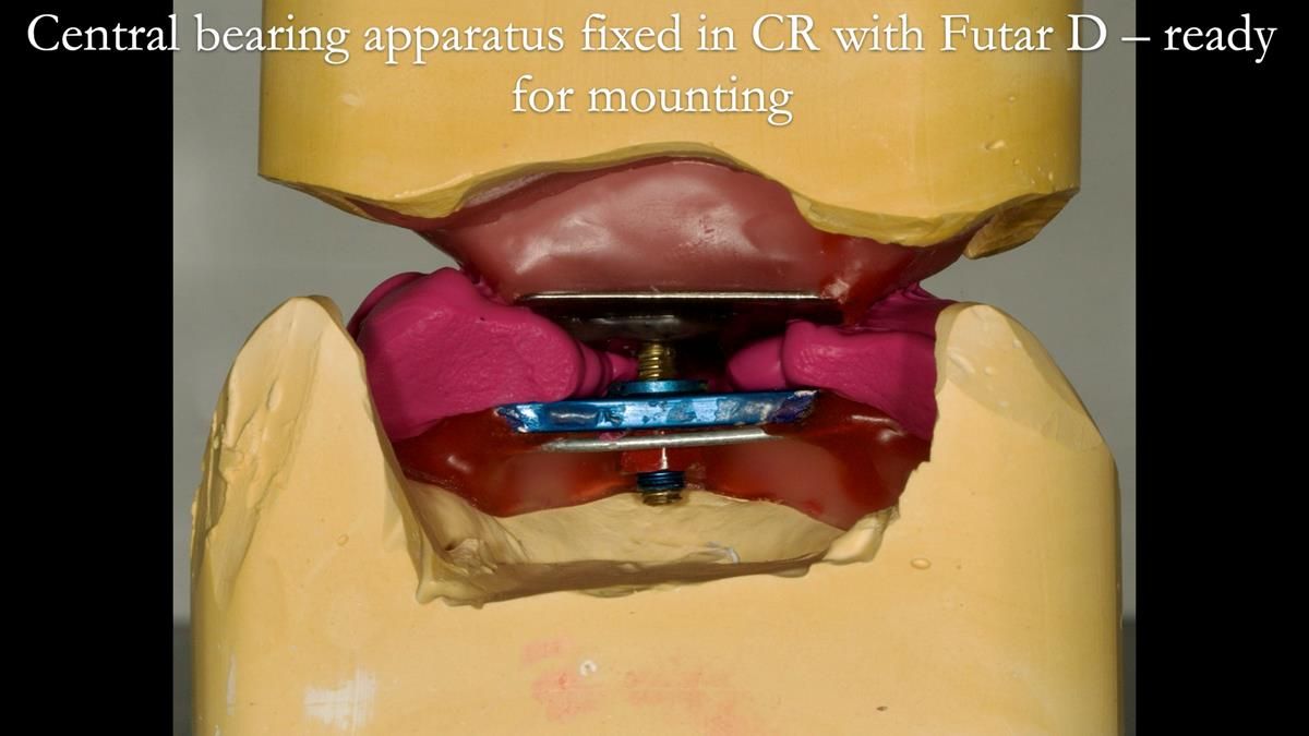 Newsletter 87 – Father Peter: A Partial Denture that needed Minor Miracle