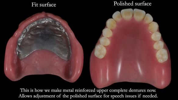 Newsletter 82 Mary - A complete upper and a one-tooth gasket denture