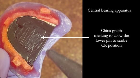 Newsletter 83: Sheila’s Complete Denture Success