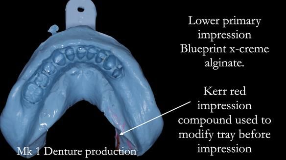 Newsletter 52 Managing Jo’s failing dentition with extractions and Mk 1/Mk 2 complete upper dentures and lower partial dentures FULL PROTOCOL