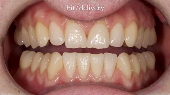 Newsletter 57 showcases the making and fitting process of implant-supported complete dentures for Alisdair