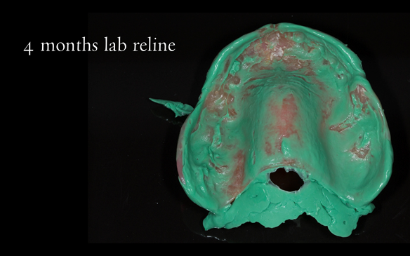 Figure 57 4 months post extraction reline impression using light bodied silicone in fitting surface using Doric Flo Light impression material. Firm placement in the mouth to ensure correct seating and border moulding