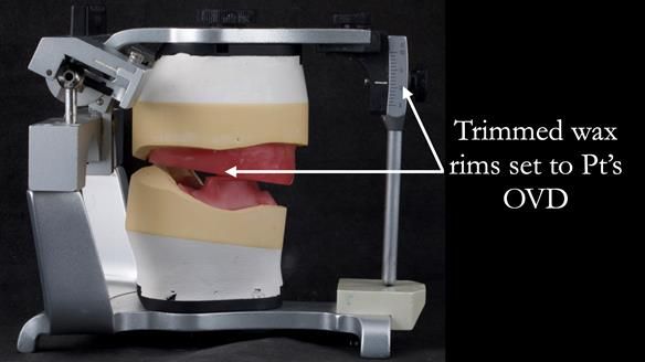 Newsletter 53 showing the making and fitting of ultra life-like dentures for Valena