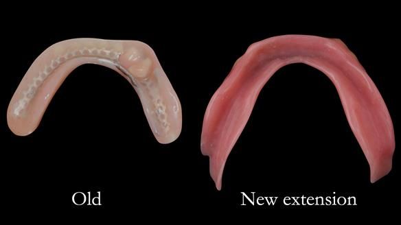 Complete denture Class II div 2 deep overbite Newsletter 39