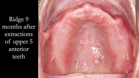 Finlay's Newsletter 62 provision of extractions and metal based complete dentures for Rafique