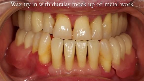 Finlay's Case Study Newsletter 40 - Immediate Mk 1 RPD to Definitive Mk 2 RPD - full protocol